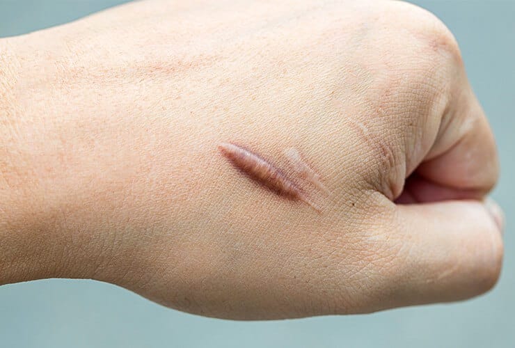 Traitement cicatrices cheloides : les meilleurs traitements pour les atténuer