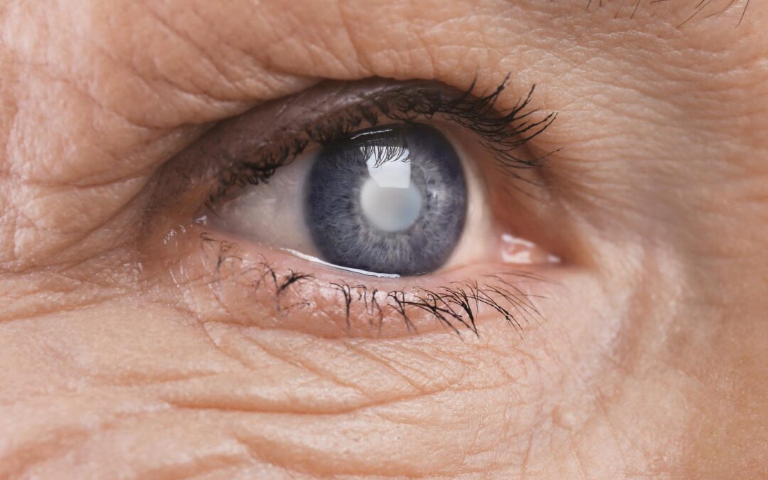 Quel est l’âge moyen pour se faire opérer de la cataracte ?