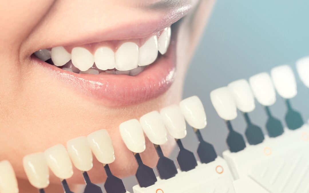 Quels sont les différents types de facettes dentaires?