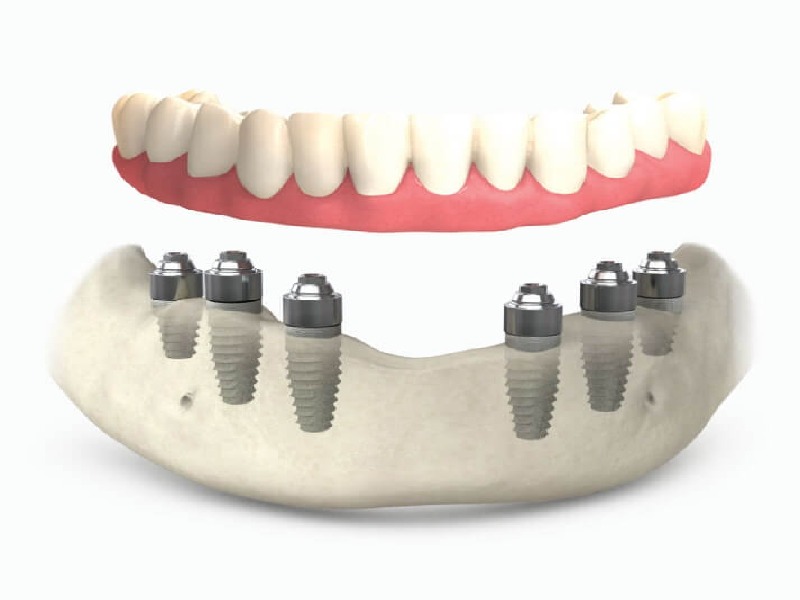 Prix implant dentaire all on 6 en Tunisie : Guide des Coûts et Options