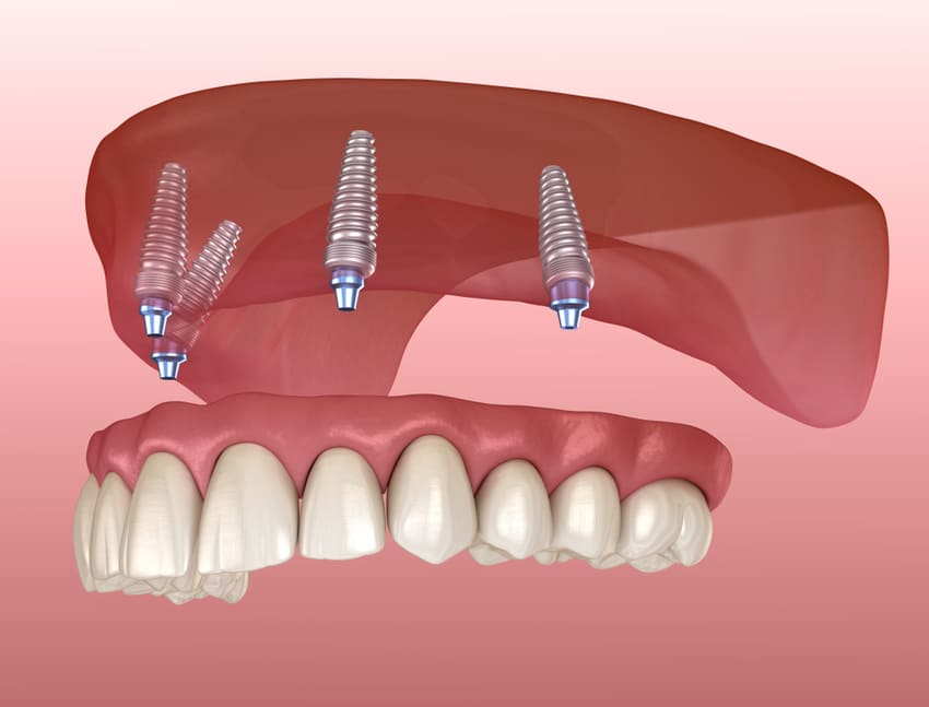 Tarif implants dentaires all-on-4 en Tunisie : Guide complet et coûts