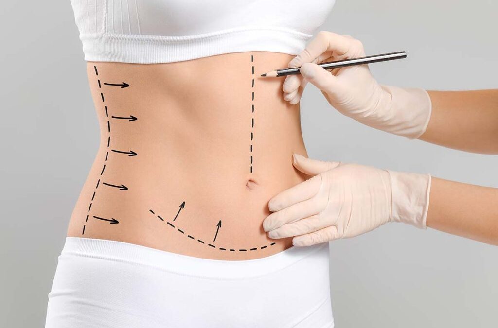 Chirurgie esthétique abdominoplastie en Tunisie prix