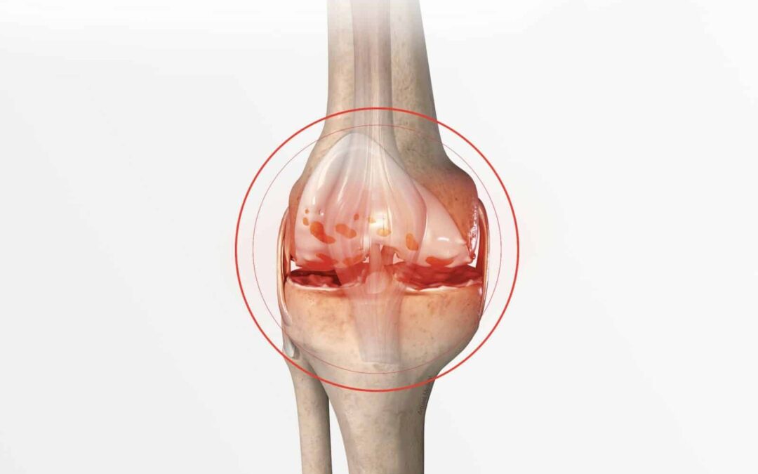 Chirurgie esthétique prothèse genoux Tunisie prix : Tarifs & Guide complet