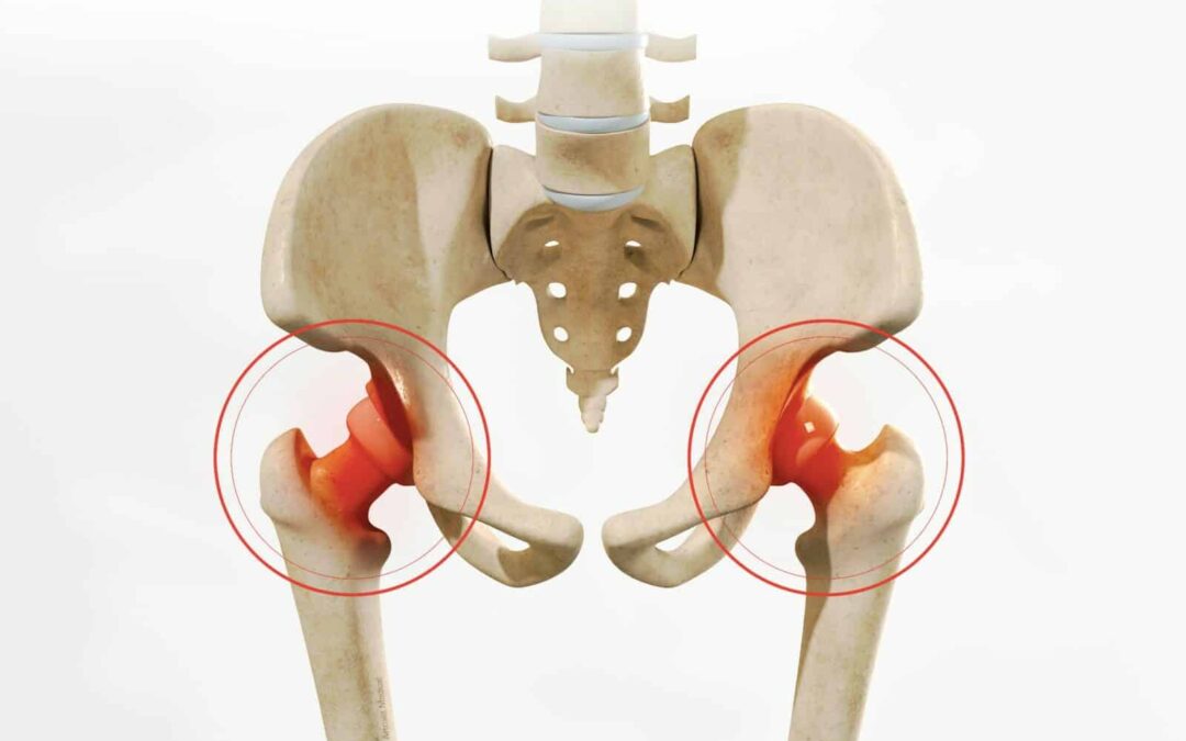 Chirurgie esthétique prothèse hanche Tunisie : Guide & informations complètes