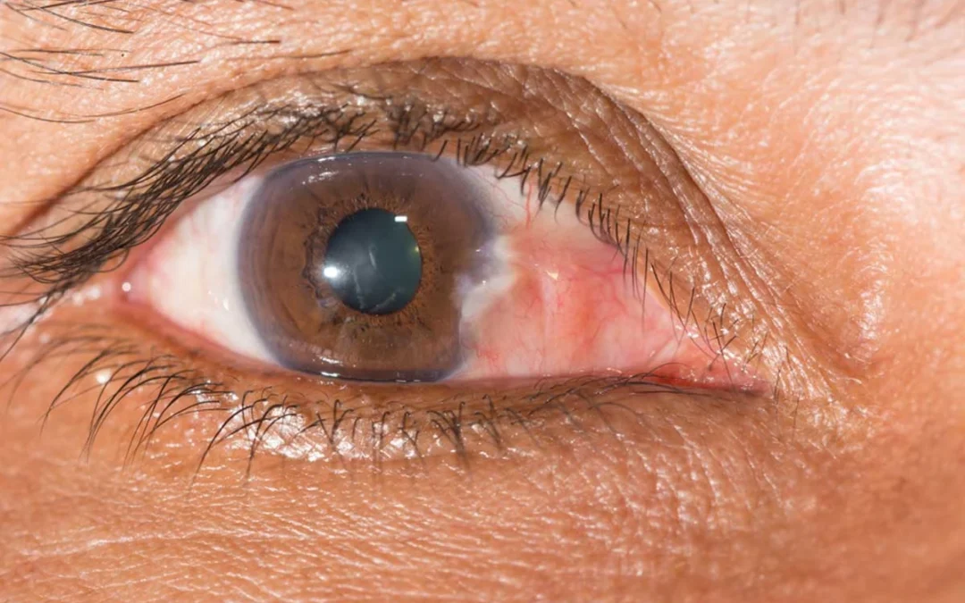 La greffe oculaire est-elle possible pour les patients atteints de glaucome ?