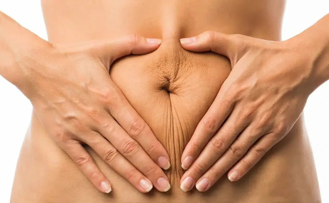 Quel est le meilleur traitement pour la peau relâchée après une perte de poids ?