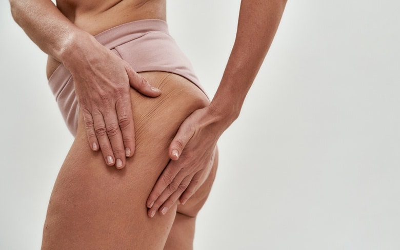 Quel est le traitement le plus efficace pour éliminer la cellulite ?