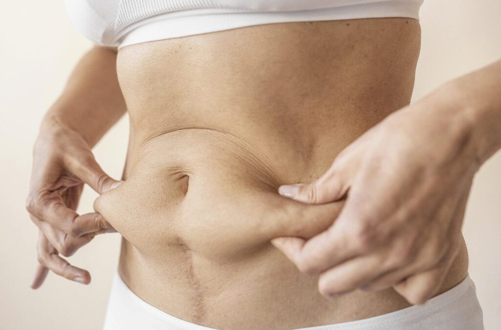 Une abdominoplastie corrige-t-elle la diastasis recti ?