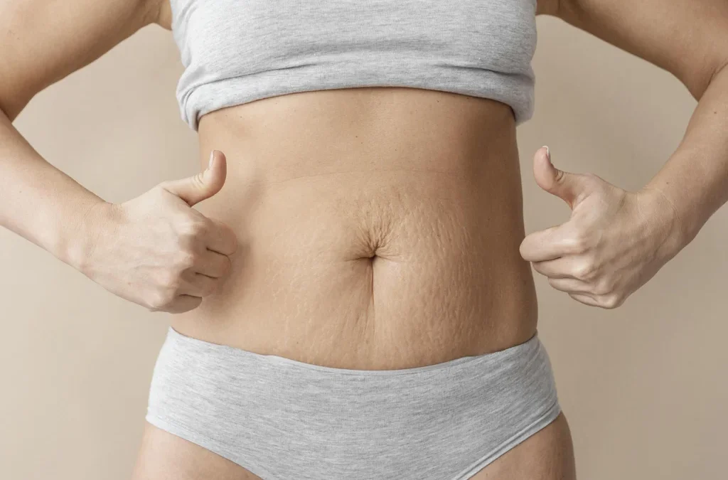 Comment puis-je corriger un diastasis des grands droits de l’abdomen ?