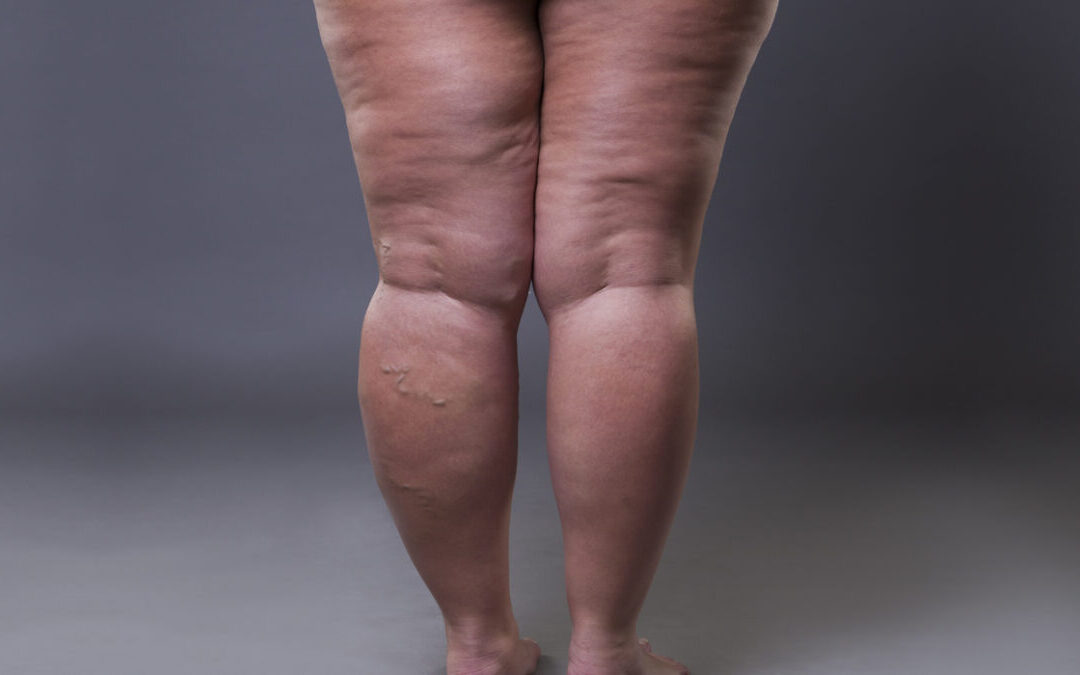 Traitement du Lipœdème en Tunisie par le Dr Youssef Gam : Solution médicale et esthétique complète