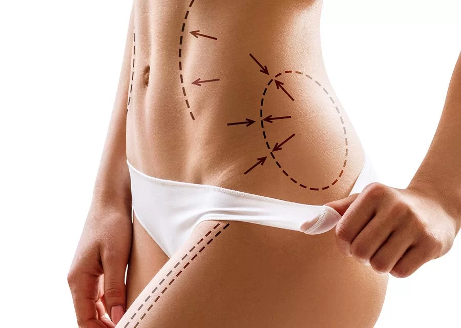 BodyTite et relâchement cutané : comment raffermir la peau après perte de poids
