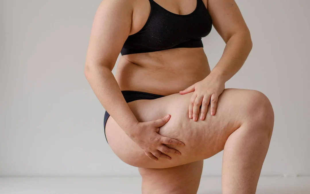 Chirurgie du Lipœdème en Tunisie : Techniques Chirurgicales Modernes pour un Traitement Durable et Sécurisé