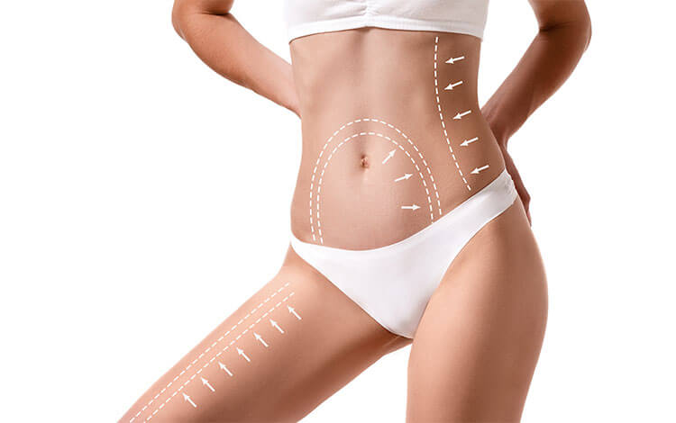 Lipœdème et liposuccion : Techniques adaptées pour des résultats durables