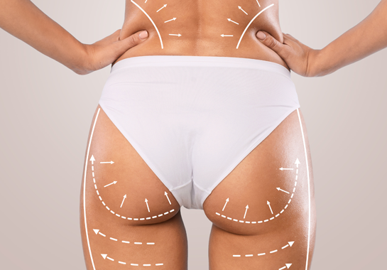 Chirurgie BBL après grossesse : Retrouver des fesses galbées et une taille affinée