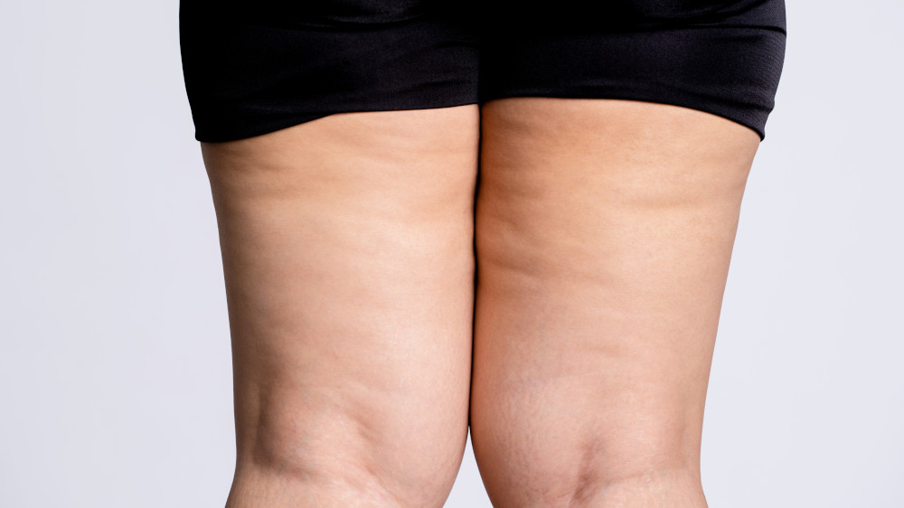 Comment diagnostiquer le lipœdème : Guide des examens cliniques et techniques d’imagerie