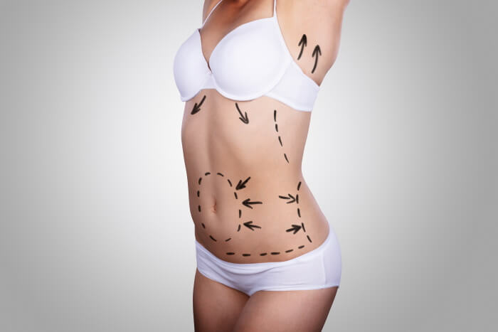 Liposuccion 4D Tunisie : Technique moderne pour un corps tonique