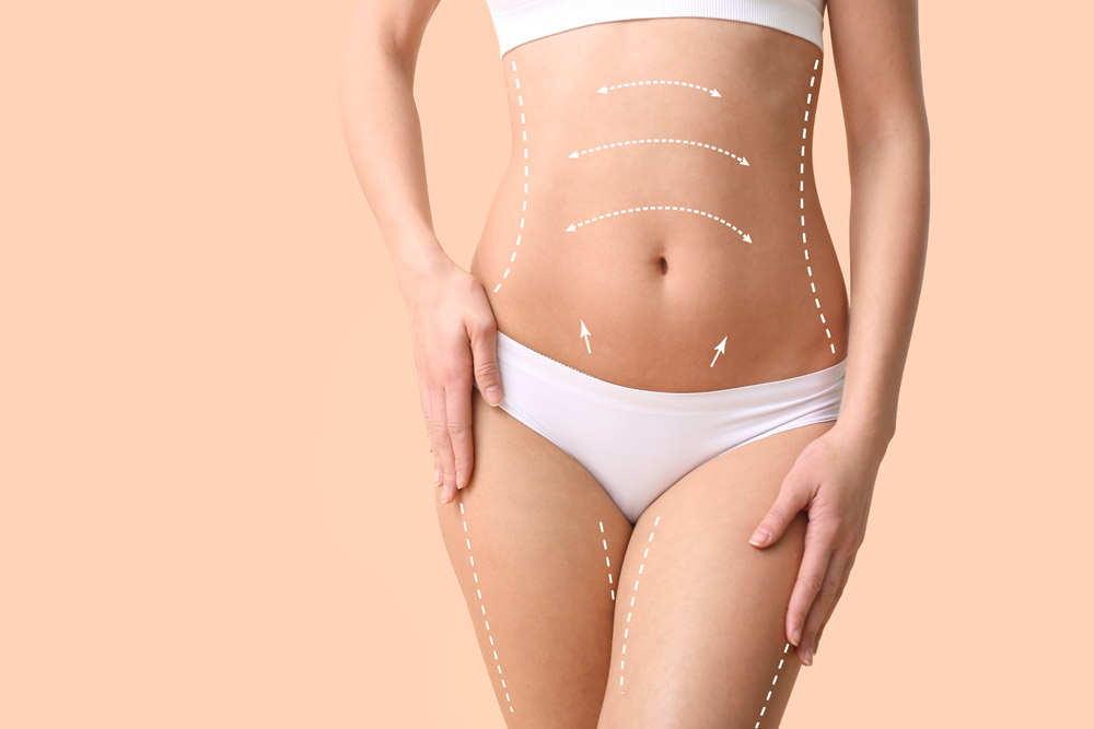 Liposuccion et Abdominoplastie : Les Avantages de la Combinaison Chirurgicale