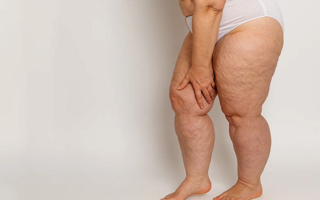 Traitement du lipœdème : l’importance d’un accompagnement psychologique personnalisé