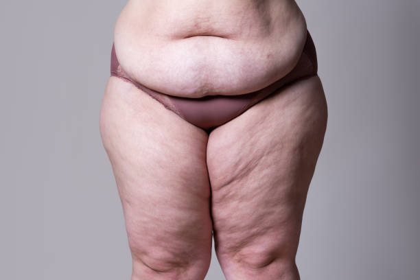 Traitement du lipoedème sévère : Expertise du Dr Ramy Ben Salah en Tunisie