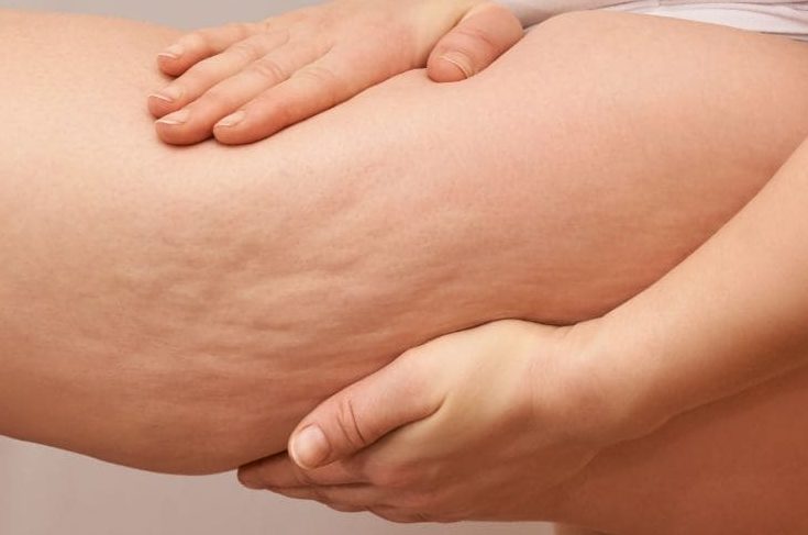 Drainage lymphatique et lipœdème : Traitement naturel et efficacité