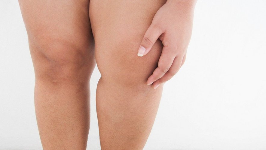 J-Plasma et Lipœdème : La technologie de dernière génération pour un raffermissement optimal