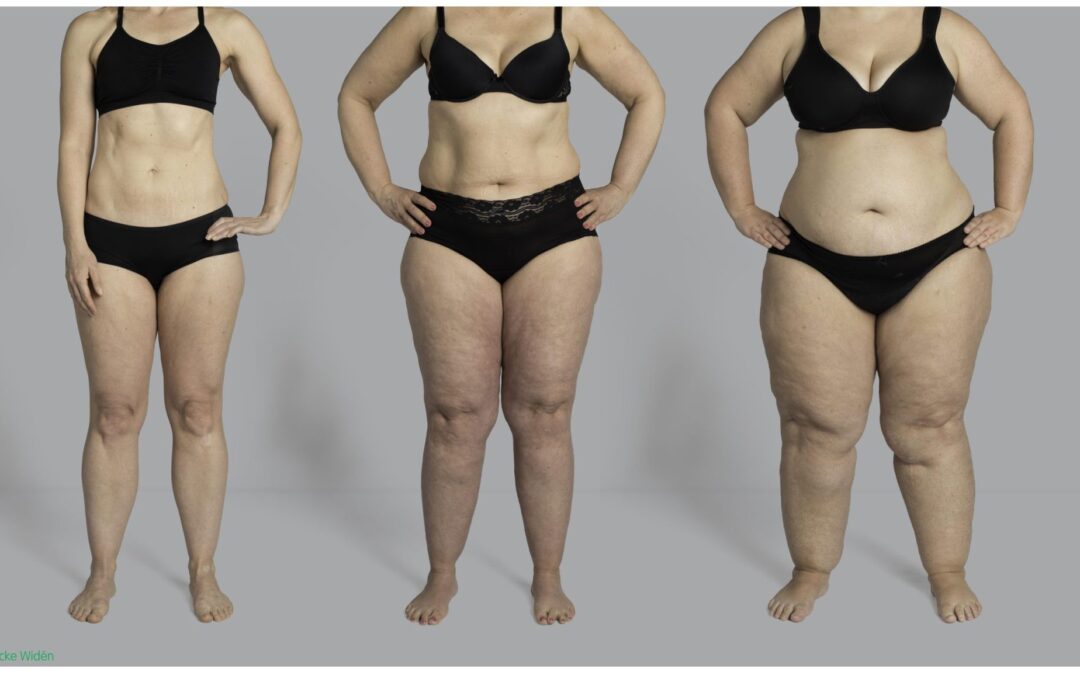 Lipœdème après grossesse : Comprendre, prévenir et traiter