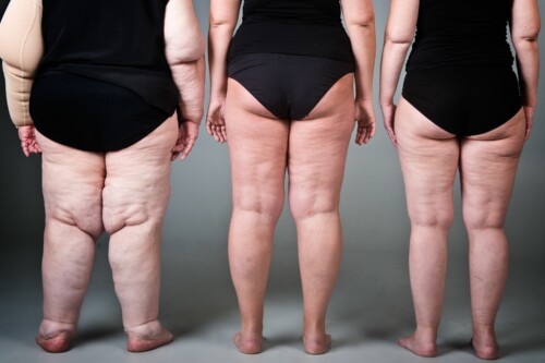 Lipœdème et hormones : pourquoi la maladie débute souvent à la puberté ?