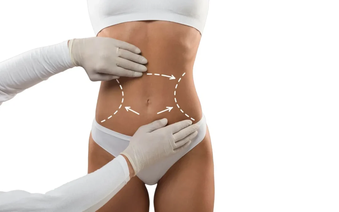 Liposuccion WAL : La technique douce pour une silhouette parfaite