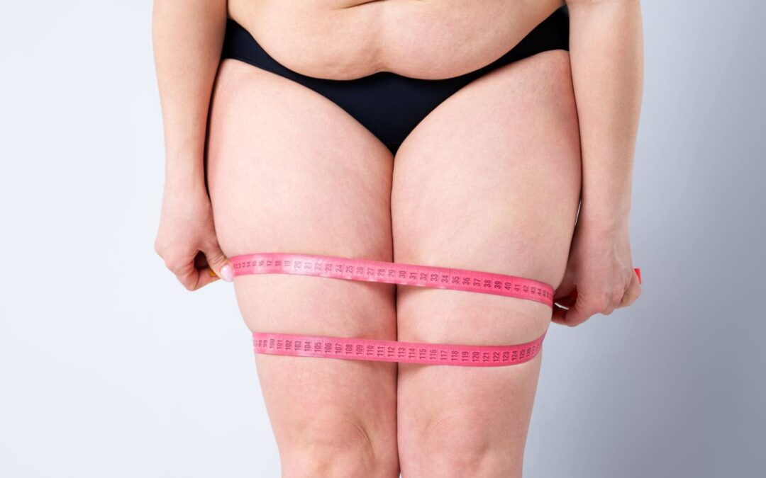 Pourquoi le lipœdème résiste-t-il aux régimes et au sport ?
