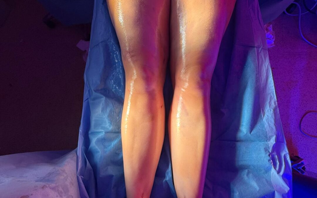 4D Lipo : une technique esthétique non adaptée au lipœdème