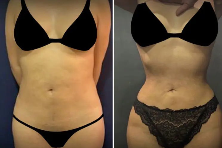 Intervention RIBXCAR : Protocole post-opératoire et bonnes pratiques selon le Dr Youssef Gam