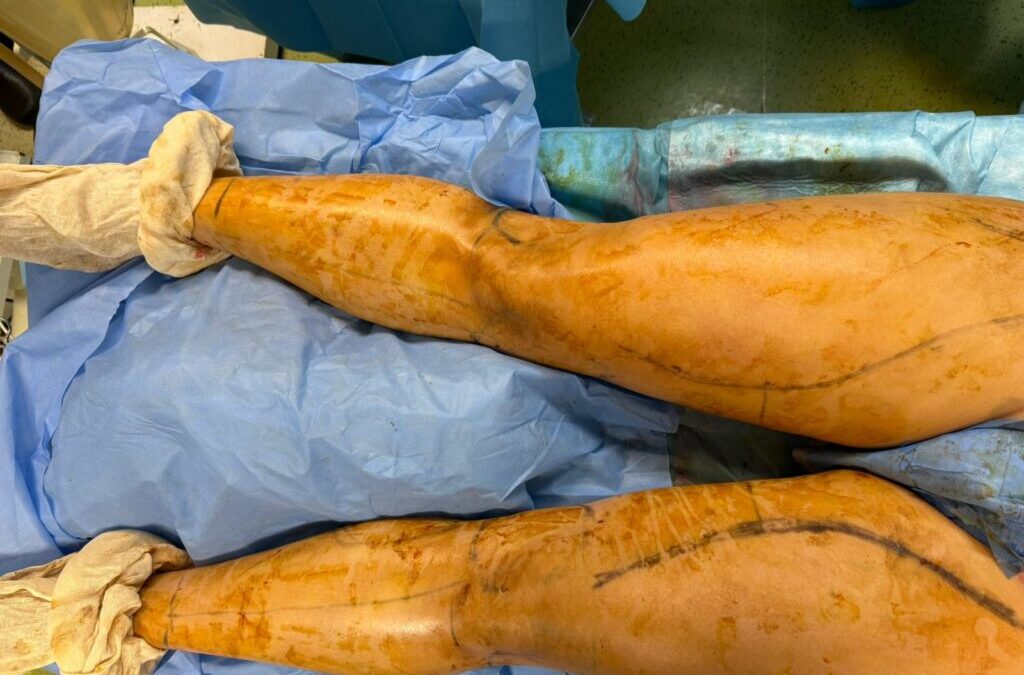 Traitement du lipoédème : la synergie entre 4-Tech et ERAS pour une récupération rapide