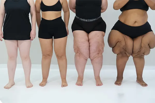 Lipœdème vs obésité : comment reconnaître les différences essentielles ?