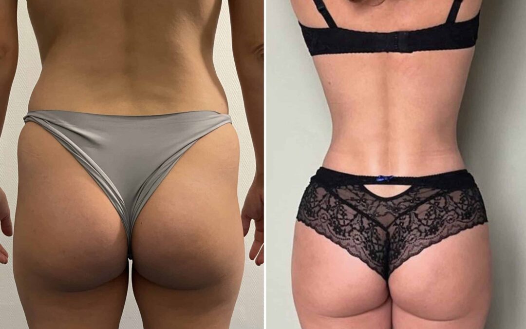 RibXcar : une technique innovante pour une transformation transgenre harmonieuse