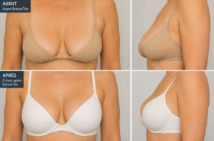 Breastite en Tunisie