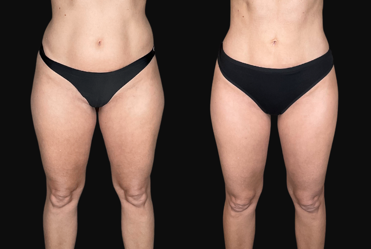 High Definition Lipedema Surgery en Tunisie : l’expertise du Dr Gam pour traiter le lipœdème