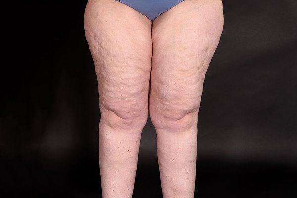 Quelle est la différence entre liposuccion esthétique et liposuccion thérapeutique du lipœdème ?