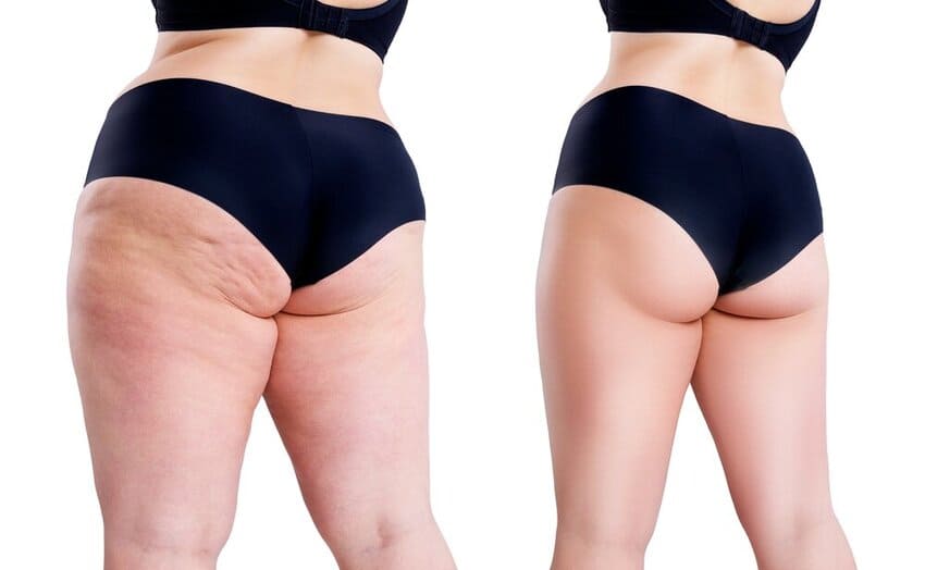 Liposuccion des cuisses avec transfert graisseux : remodeler la silhouette et harmoniser les proportions