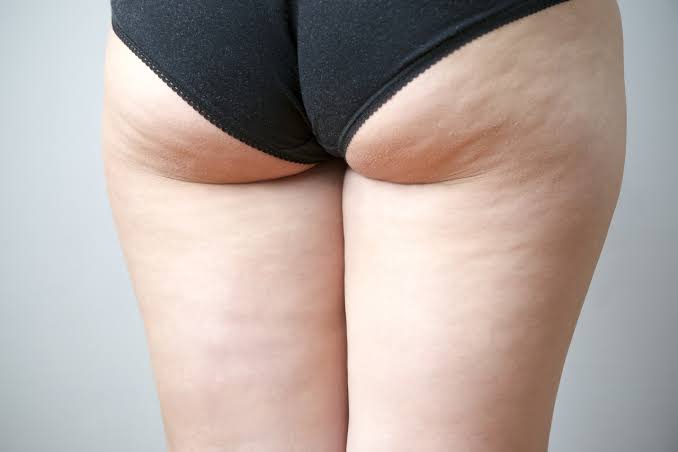 Liposuccion et cellulite : pourquoi la technique ne traite-t-elle pas tous les aspects de la cellulite ?