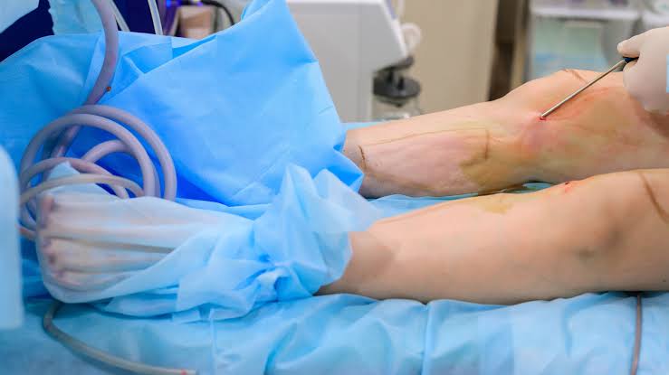 Liposuccion des genoux : corriger les amas graisseux localisés