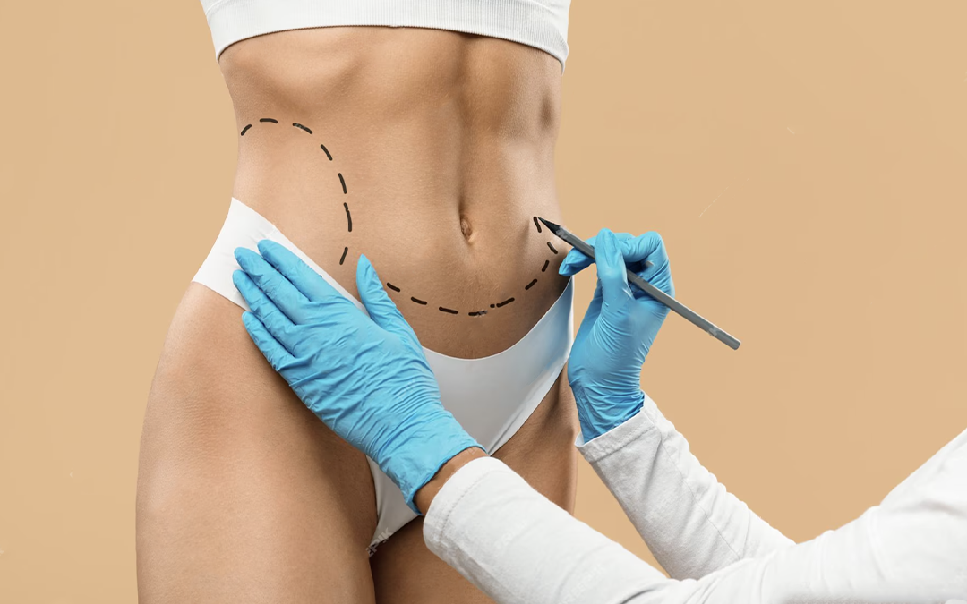 Liposuccion abdominale avec J-Plasma : quelles possibilités pour raffermir la peau ?