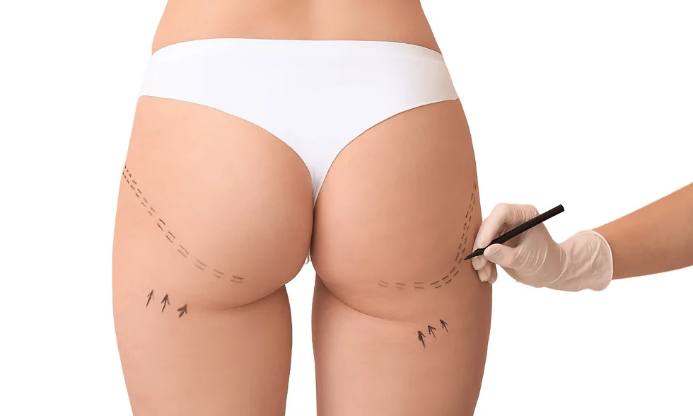 Liposuccion des flancs et lipofilling fessier : comment redessiner la taille et les fesses ?