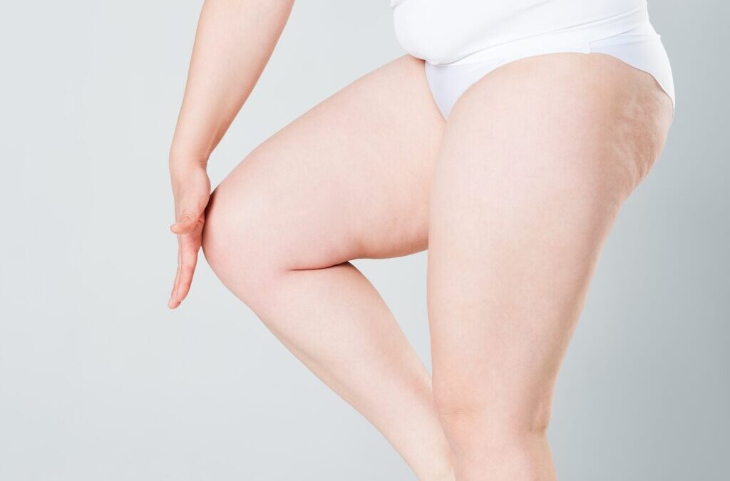 Liposuccion du lipœdème et protocole ERAS : comment optimiser la récupération après l&rsquo;intervention ?