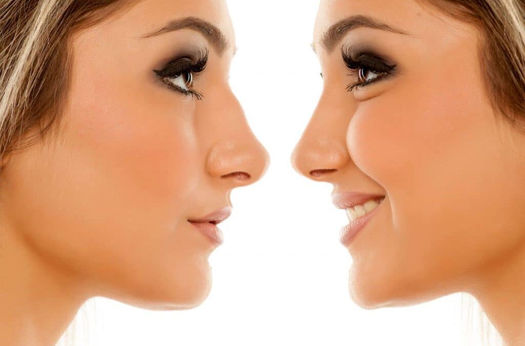 Rhinoplastie de la pointe large : quelles techniques pour affiner le nez et harmoniser le visage ?